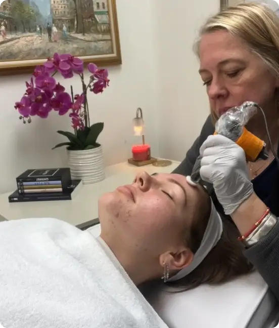 ProCell microchanneling treatment for acne scarring and skin texture improvement in Athens GA.