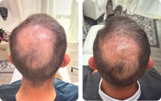 Traditional microneedling pen creating skin channels for acne scar and anti-aging treatment